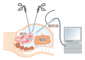 腹腔鏡手術
