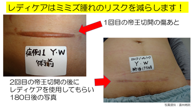レディケアはミミズ腫れのリスクを減らします