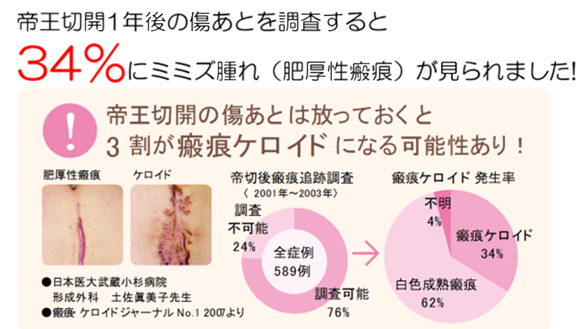 帝王切開１年後の傷あとを調査すろと