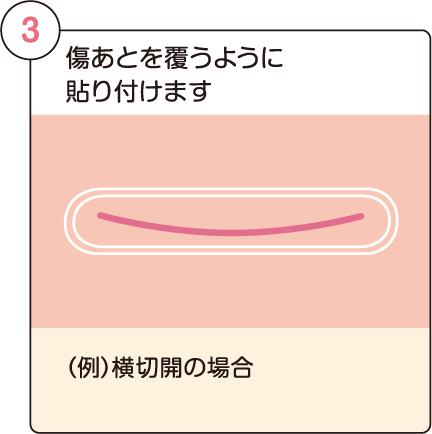 傷あとを覆うように貼り付 けます